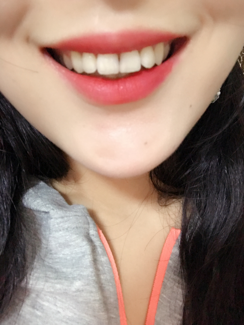 保定東陽口腔醫(yī)院白小青醫(yī)生做牙齒矯正怎么樣?附牙齒矯正案例效果對(duì)比圖