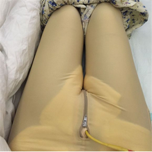 保定市第五醫(yī)院美容整形科做大腿吸脂怎么樣？附劉根立醫(yī)生案例效果圖