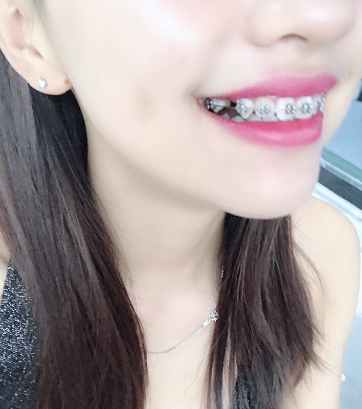 保定東陽口腔醫(yī)院溫興醫(yī)生做牙齒矯正怎么樣？附牙齒矯正案例效果對比圖