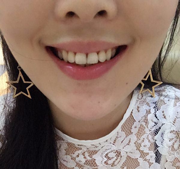 保定東陽口腔醫(yī)院白小青醫(yī)生做牙齒矯正怎么樣?附牙齒矯正案例效果對(duì)比圖