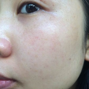 寶雞皮膚病醫(yī)院文東亮醫(yī)生做臉部祛斑效果怎么樣？附臉部祛斑案例