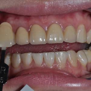 保定東陽口腔醫(yī)院張亞靜醫(yī)生做牙齒冷光美白怎么樣？附冷光美白案例效果對比圖