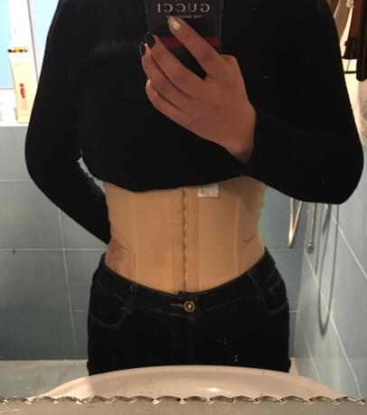 保定現(xiàn)代女子醫(yī)院整形美容中心做腰腹部吸脂怎么樣？附林秀蓮醫(yī)生案例效果圖