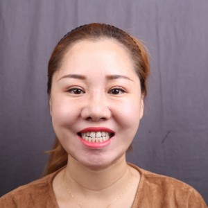 保定東陽(yáng)口腔醫(yī)院趙晨醫(yī)生做瓷貼面怎么樣?附瓷貼面案例效果對(duì)比圖