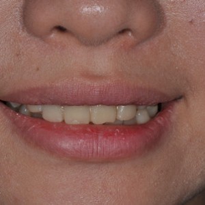 保定東陽口腔醫(yī)院張亞靜醫(yī)生做牙齒冷光美白怎么樣？附冷光美白案例效果對比圖