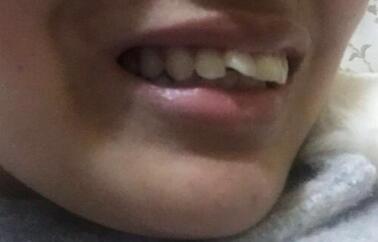 保定東陽口腔醫(yī)院馮春城醫(yī)生做烤瓷牙怎么樣?附烤瓷牙案例效果對比圖 保定東陽口腔醫(yī)院馮春城醫(yī)生做烤瓷牙怎么樣?附烤瓷牙案例效果對比圖