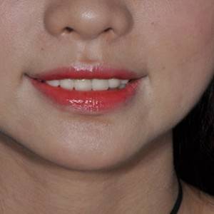 保定東陽口腔醫(yī)院張亞靜醫(yī)生做牙齒冷光美白怎么樣？附冷光美白案例效果對比圖