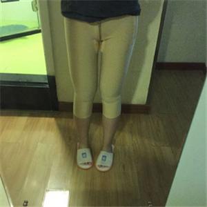 保定市第五醫(yī)院美容整形科做大腿吸脂怎么樣？附劉根立醫(yī)生案例效果圖