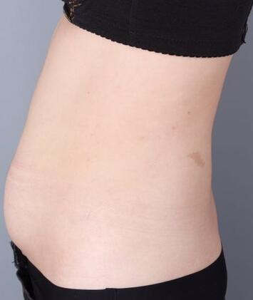 保定現(xiàn)代女子醫(yī)院整形美容中心做腰腹部吸脂怎么樣？附林秀蓮醫(yī)生案例效果圖