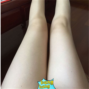 保定市第五醫(yī)院美容整形科做大腿吸脂怎么樣？附劉根立醫(yī)生案例效果圖