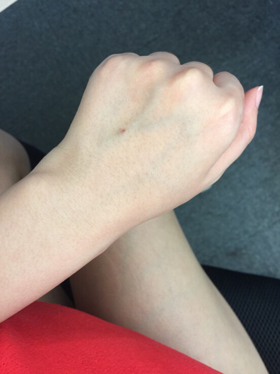 蚌埠市第三人民醫(yī)院燒傷整形科李方奇注射美白針效果怎么樣？安全嗎？附案例