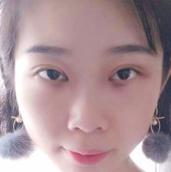 保定安卓貝拉醫(yī)療美容門(mén)診部孫大山醫(yī)生做雙眼皮+去眼袋怎么樣？附案例效果對(duì)比圖