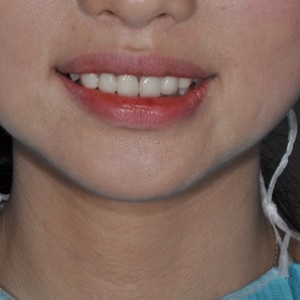 保定東陽口腔醫(yī)院張亞靜醫(yī)生做牙齒冷光美白怎么樣？附冷光美白案例效果對比圖