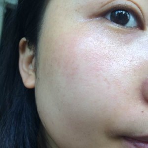 寶雞皮膚病醫(yī)院文東亮醫(yī)生做臉部祛斑效果怎么樣？附臉部祛斑案例