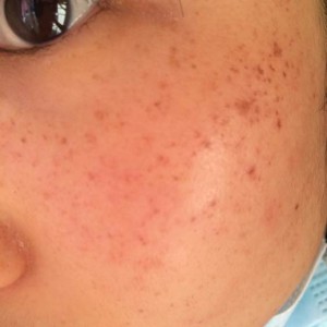 寶雞皮膚病醫(yī)院文東亮醫(yī)生做臉部祛斑效果怎么樣？附臉部祛斑案例