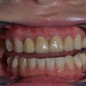 保定東陽口腔醫(yī)院張亞靜醫(yī)生做牙齒冷光美白怎么樣？附冷光美白案例效果對比圖