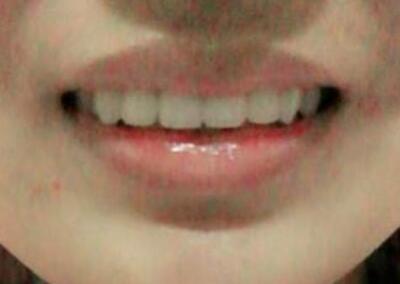 保定東陽口腔醫(yī)院馮春城醫(yī)生做烤瓷牙怎么樣?附烤瓷牙案例效果對比圖 保定東陽口腔醫(yī)院馮春城醫(yī)生做烤瓷牙怎么樣?附烤瓷牙案例效果對比圖