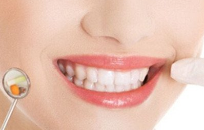 美容冠矯正是什么意思？