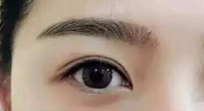 眼角修復多久能恢復？