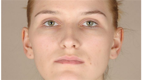 鐳射凈膚多少錢一次？