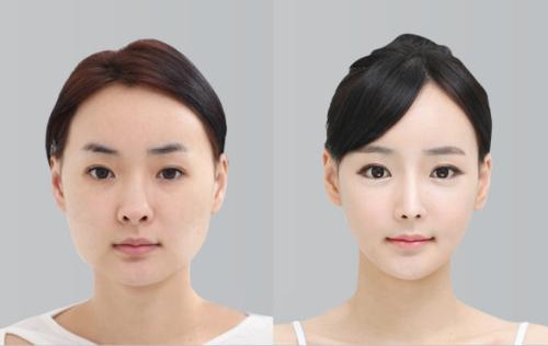 想做歐式雙眼皮，什么是歐式雙眼皮？