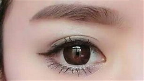 雙眼皮幾天拆線最好？大概多久能恢復(fù)自然？