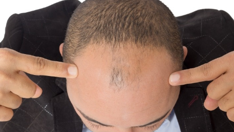 頭發(fā)種植需要多少錢？