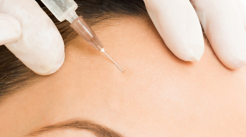 自體脂肪豐面頰的效果能維持多久？