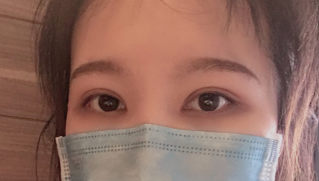 全切雙眼皮會(huì)越來(lái)越窄嗎？