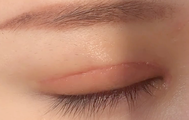 全切雙眼皮多久恢復？全切開雙眼皮有哪些優(yōu)點？