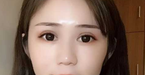 全切雙眼皮會(huì)越來(lái)越窄嗎？全切雙眼皮消腫的辦法有哪些？