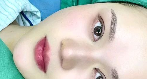 全切雙眼皮多長時間能恢復(fù)？