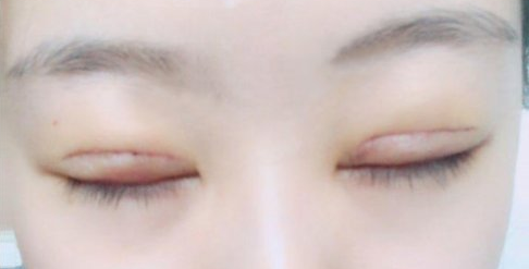 全切雙眼皮術(shù)后會留疤嗎？