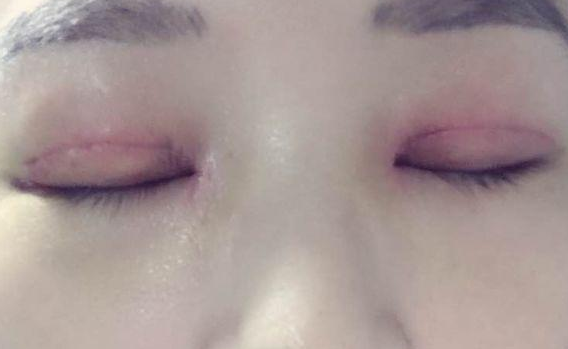 全切雙眼皮不對稱怎么辦？