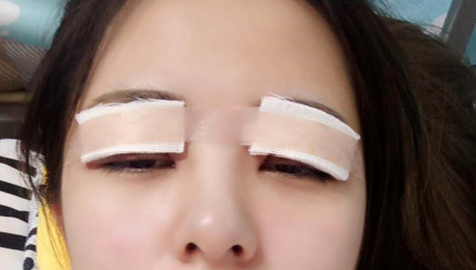 全切雙眼皮怎么恢復(fù)快？