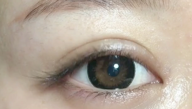 全切雙眼皮失敗可以修復(fù)嗎？