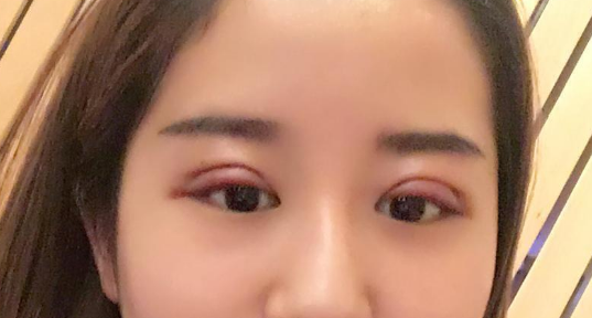 全切雙眼皮好不好？