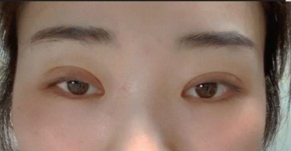 什么是全切雙眼皮？全切雙眼皮的恢復(fù)時(shí)間？