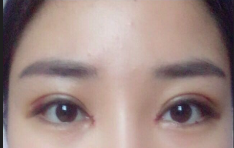 雙眼皮全切術(shù)后注意事項有哪些？