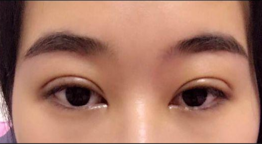 全切雙眼皮的危害有哪些？