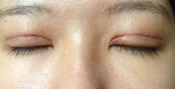 全切雙眼皮到底疼不疼？