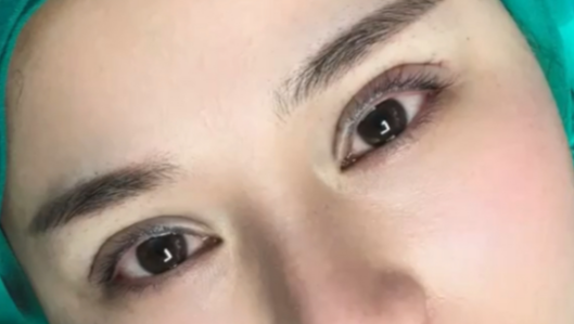全切雙眼皮有危險嗎？