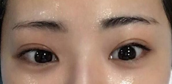 全切雙眼皮適合哪些人？