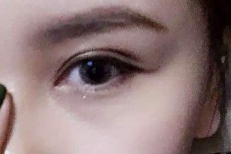 全切雙眼皮多久恢復(fù)好可以看到效果？全切雙眼皮需要多少錢？