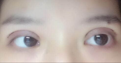 全切雙眼皮修復(fù)后恢復(fù)期多久？