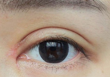 什么是全切雙眼皮？
