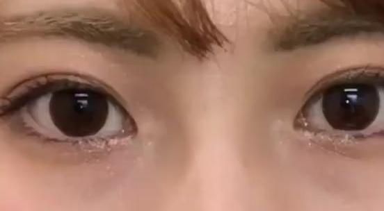 雙眼皮埋線后還可以開眼角嗎？做埋線雙眼皮有什么危險？