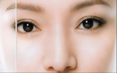 埋線雙眼皮用不用抽脂？