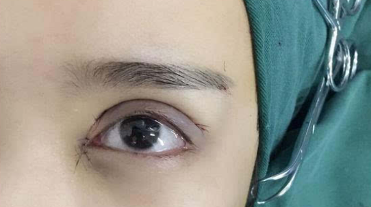 埋線雙眼皮會(huì)不會(huì)脫線？