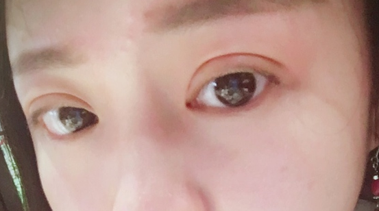 埋線雙眼皮可以保持幾年？埋線雙眼皮的危害有哪些？
